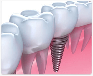 best dental implant clinic in chennai
