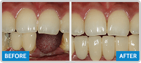 Before After