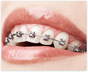 teeth braces cost in Chennai