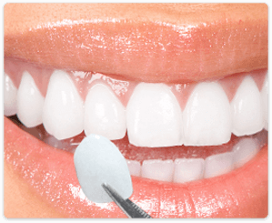 dental veneers cost in Chennai