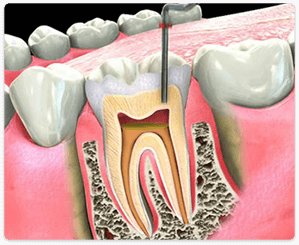 Root canal doctor near me