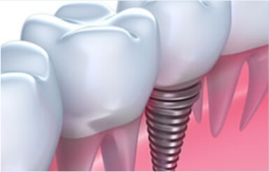 Dental Implants